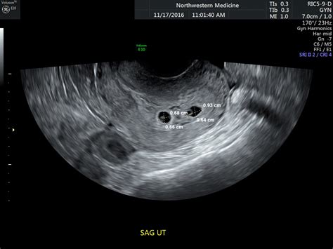 dating scan molar pregnancy